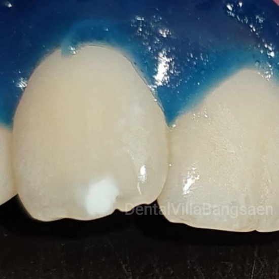 Laser Dentistry  เลเซอร์ทางทันตกรรม เลเซอร์แก้ปัญหายิ้มเห็นเหงือก - คลินิกทันตกรรมเด็นทัลวิลลา ชลบุรี