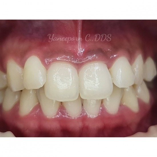 เลเซอร์เหงือกชมพู แก้เหงือกดำ - Dental Villa