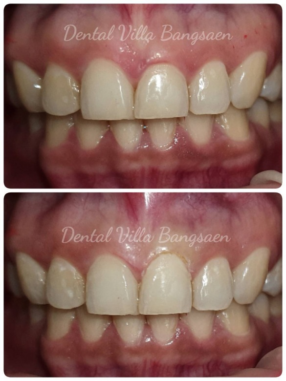 เลเซอร์ทางทันตกรรม Laser Dentistry บางแสน เลเซอร์ทางทันตกรรม Laser Dentistry บางแสน