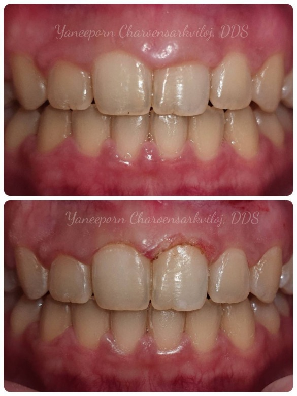 Laser Dentistry เลเซอร์ทางทันตกรรม Laser Dentistry เลเซอร์ทางทันตกรรม